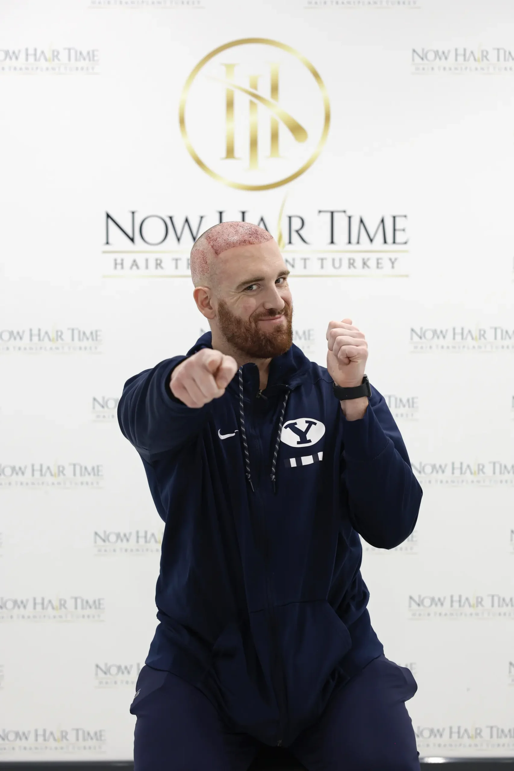 على أمل التخلص من لقب العذراء الأصلع إلى الأبد، خضع كينيون لعملية زراعة شعر في تركيا بتكلفة أقل من 5000 دولار.